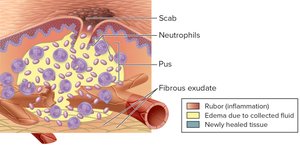 Pus formation and tissue repair during inflammation