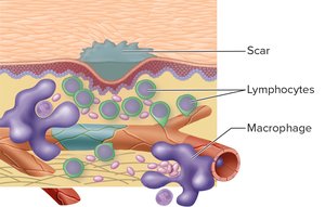 Scar formation and immune cell involvement in healing