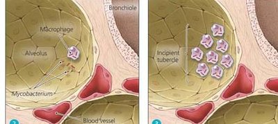 Tissue damage and inflammation