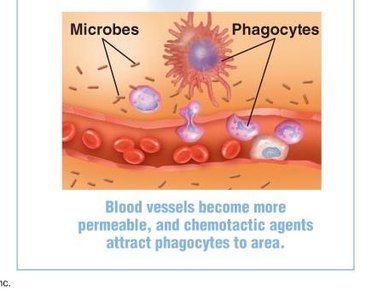 Inflammation induced by complement activation
