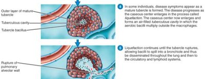 Pathogenesis of tuberculosis: progression and rupture of tubercles