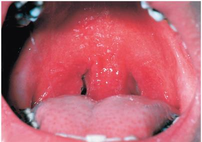 Streptococcal pharyngitis (strep throat)