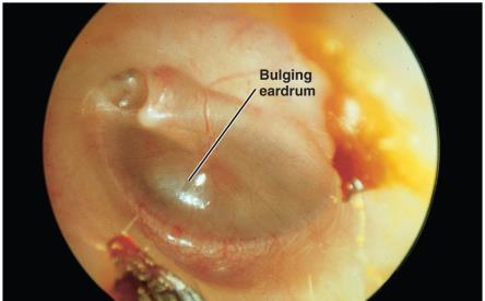 Acute otitis media with bulging eardrum
