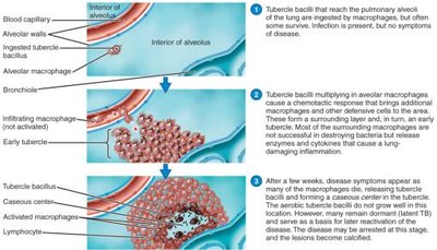 Pathogenesis of tuberculosis: formation of tubercles