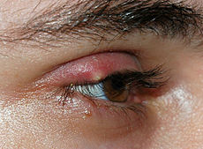 Sty (stye) on eyelid