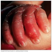 Scalded skin syndrome on hand
