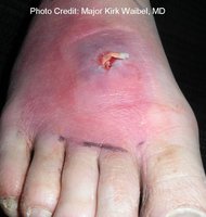 MRSA infection on foot