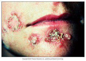 Impetigo on face