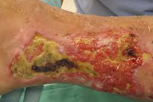 Necrotizing fasciitis with tissue necrosis