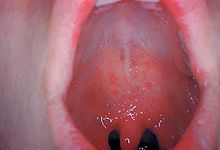 Rash on mucous membranes (enanthem)