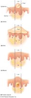 Diagram showing types of skin lesions and pus formation