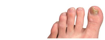Athlete's foot caused by Tinea pedis