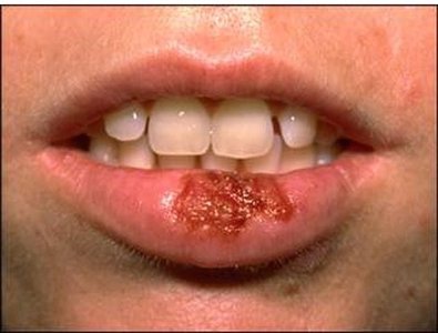 Smallpox lesions on hand
