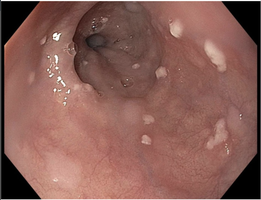 Endoscopic image of esophageal candidiasis