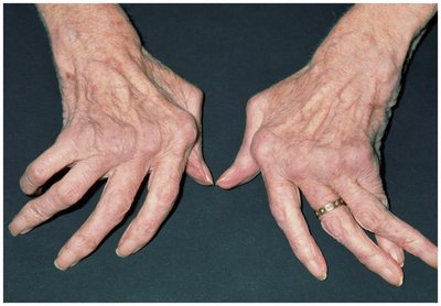Photograph of hands affected by rheumatoid arthritis