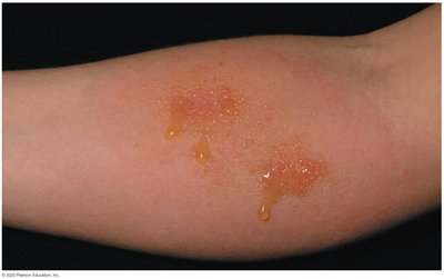 Photograph of contact dermatitis on the skin