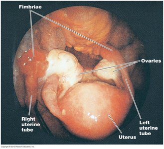Pelvic inflammatory disease (PID) affecting reproductive organs
