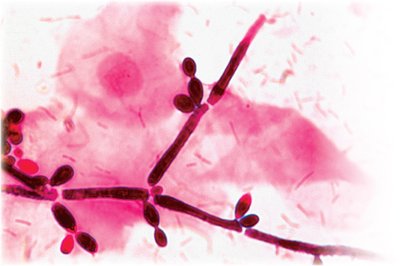 Gram stain of Candida albicans in a vaginal smear