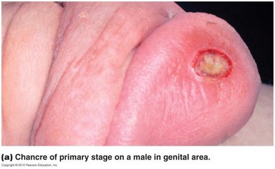 Primary syphilitic chancre on male genitalia