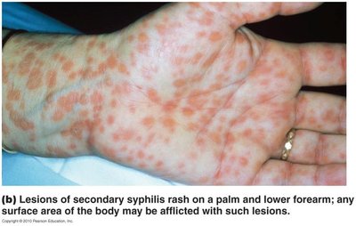 Secondary syphilis rash on palm