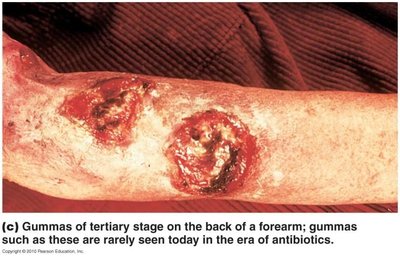 Tertiary syphilis gummas on forearm