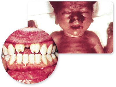 Congenital syphilis with Hutchinson's teeth