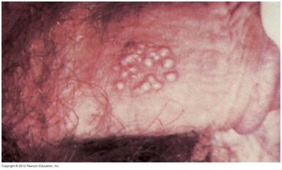 Genital herpes vesicles on genitalia