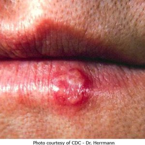 Herpes simplex virus lesion on the lip (cold sore)