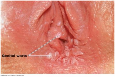 Extensive genital warts (condyloma acuminata)