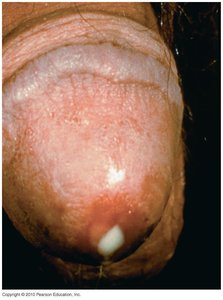 Male urethral discharge in gonorrhea