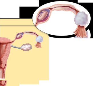 Ectopic pregnancy due to tubal scarring