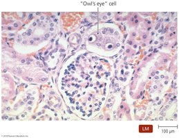 Owl's eye cell in CMV infection