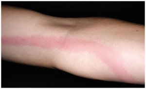 Lymphangitis, a sign of septicemia