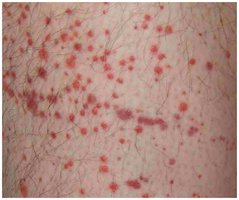 Petechiae, a sign of bacteremia