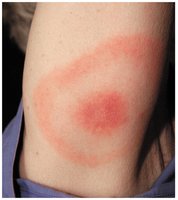 Bull's-eye rash of Lyme disease