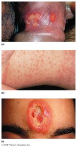 Lesions of syphilis