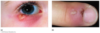 Herpes lesions of the eyes and skin