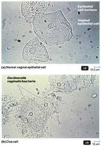 Clue cells in bacterial vaginosis