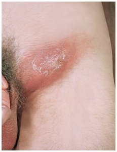 Advanced case of lymphogranuloma venereum