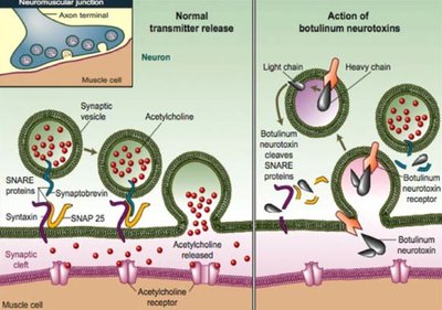 Diagram showing normal neurotransmitter release and blockage by botulinum toxin