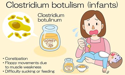 Infographic: Clostridium botulinum in infants and honey