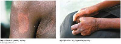 Photos of tuberculoid and lepromatous leprosy