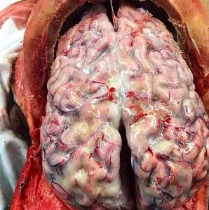 Photograph of inflamed meninges covering the brain