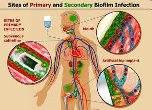 Sites of primary and secondary biofilm infection in humans