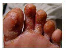 Pseudomonas infection on skin