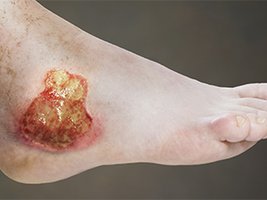 Image of chronic wound associated with biofilm infection