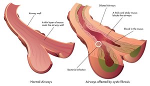 Diagram of airways affected by cystic fibrosis and bacterial infection