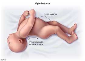 Image of opisthotonos, a symptom of tetanus