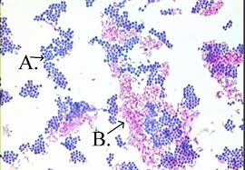 Acid-fast bacilli in sputum