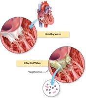Healthy vs. infected heart valve with vegetations
